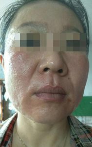 1岁激素皮炎患者，痊愈后，面部皮肤是什么样呢？"