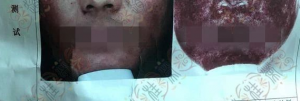 美女用皮炎平治疗脸部过敏红痒，结果出现了面部激素依赖性皮炎！