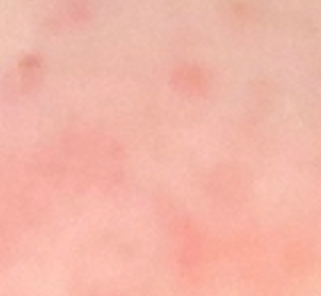 皮肤过敏瘙痒红肿的原因，皮肤过敏身上痒怎么办？