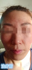 激素脸症状初期图片治愈过程记录 | 赵桂荣中医门诊部
