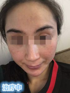 赵桂荣门诊 ：对症治疗红血丝、敏感肌肤、激素依赖性皮炎