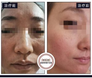 激素依赖性皮炎治疗案例：赵桂荣阐述激素脸治疗方法的两个关键点