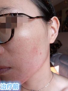 激素依赖性皮炎治愈案例：毛孔粗大、面部潮红、干燥脱皮、逆光疹子治疗方法