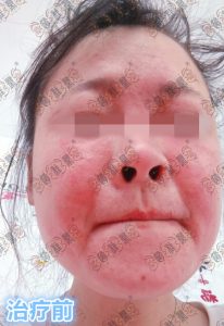 面部激素依赖性皮炎治疗疗程观察