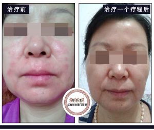 激素脸赵桂荣治疗1个疗程，皮肤能恢复到什么程度？