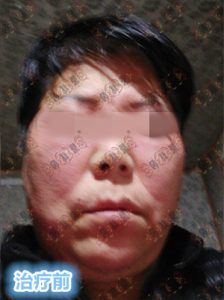 赵桂荣门诊：面部激素依赖性皮炎治疗疗程案例