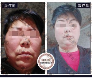赵桂荣门诊：面部激素依赖性皮炎治疗疗程案例