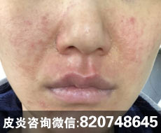 赵桂荣门诊：面部激素依赖性皮炎的皮损与皮痒