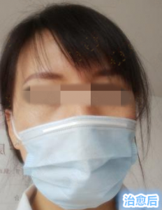 赵桂荣中医门诊部：面部激素依赖性皮炎治疗5个疗程后