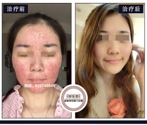 赵桂荣门诊：面部激素依赖性皮炎的皮损与皮痒