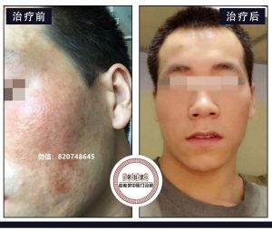 赵桂荣激素依赖性皮炎专家给激素脸患者的几点建议