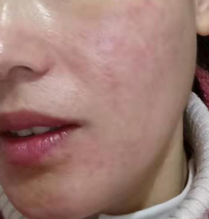 激素脸过敏治愈案例：脸不过敏了，皮肤没有任何不舒服！