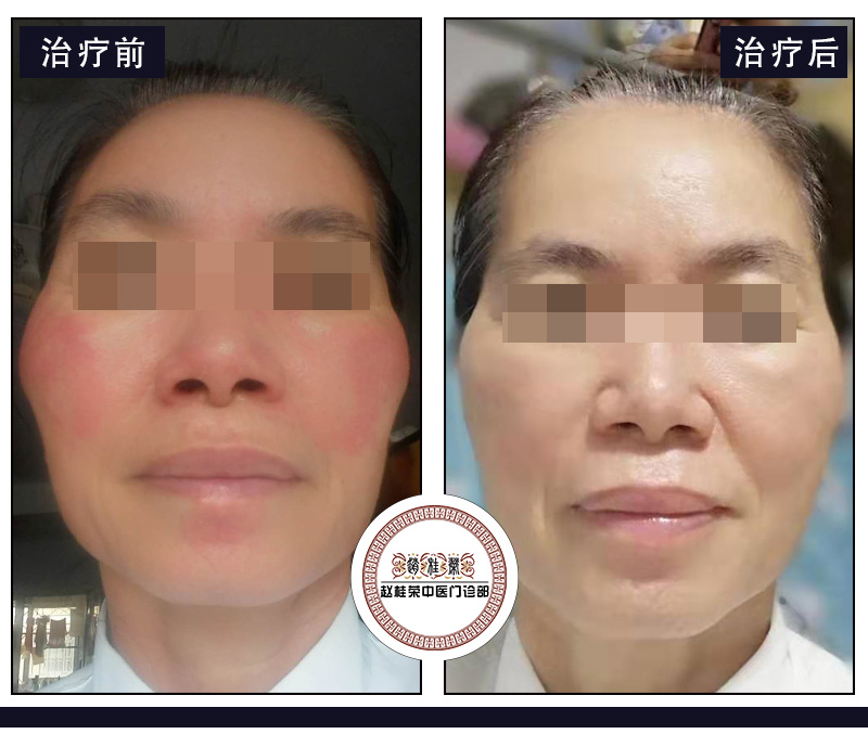 激素脸在治疗修复期可以化妆吗？