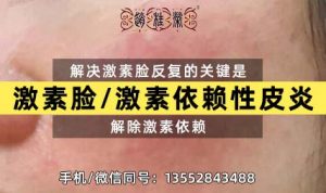 赵桂荣门诊：激素脸恢复需要多久？