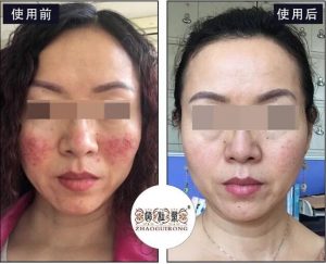 用化妆品皮肤就会红肿发痒，停用就能稍好，这种面部皮肤问题是激素依赖性皮炎吗？