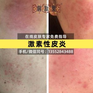 赵桂荣：激素脸能用隔离有防晒作用的霜吗？