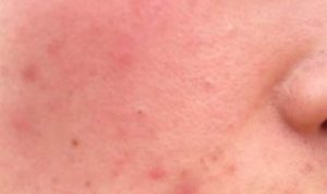 用化妆品皮肤就会红肿发痒，停用就能稍好，这种面部皮肤问题是激素依赖性皮炎吗？