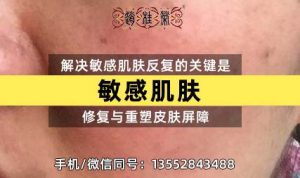 湿敷生理盐水对激素脸有帮助吗？为什么生理盐水的浓度是0.9%？