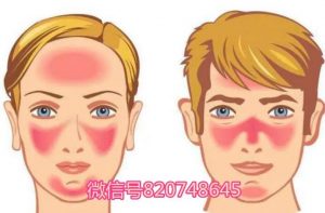 玫瑰痤疮要警惕四种病？玫瑰痤疮的8个排毒表现？