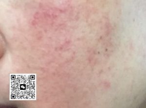 拯救激素脸可以从这几个方面入手